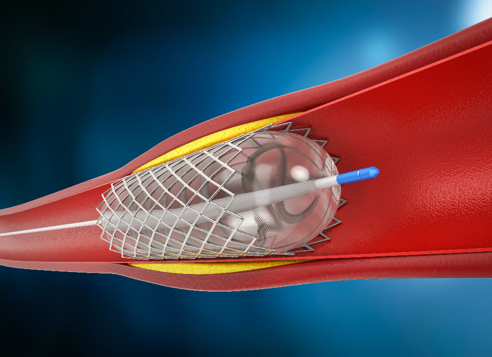 <strong>Angioplastia con stent</strong>