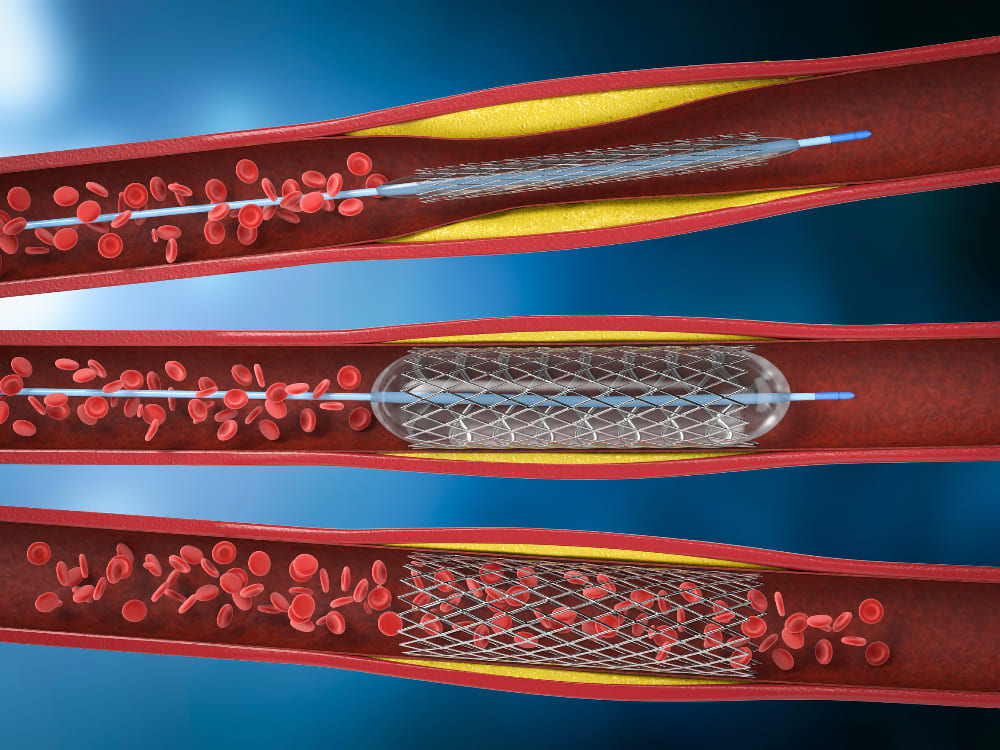 <strong><a href='angioplastia-en-quito.php'><strong>Angioplastia en Quito</strong></a></strong>