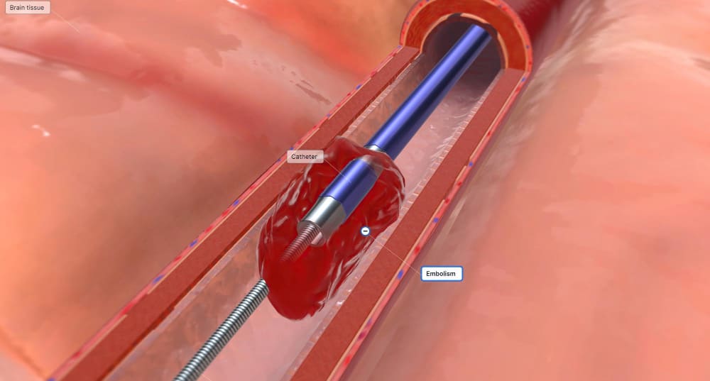 <strong><a href='cirugia-endovascular-avanzada-en-ecuador.php'><strong>Cirugía</strong> <strong>endovascular</strong> <strong>avanzada en Ecuador</strong></a></strong>