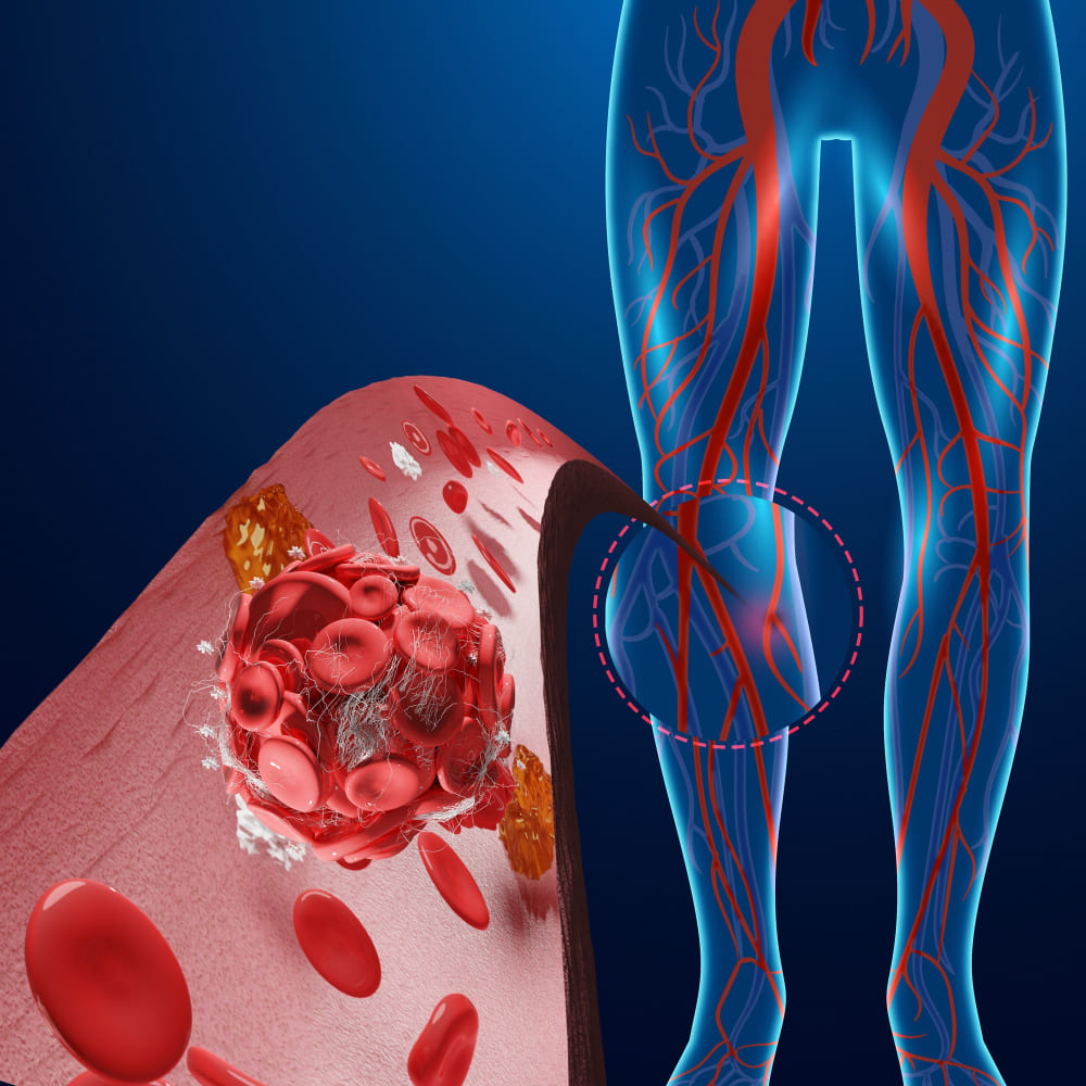 <strong><a href='tratamiento-de-enfermedad-arterial-periferica.php'><strong>Tratamiento de enfermedad</strong> <strong>arterial</strong> <strong>periférica</strong></a></strong>