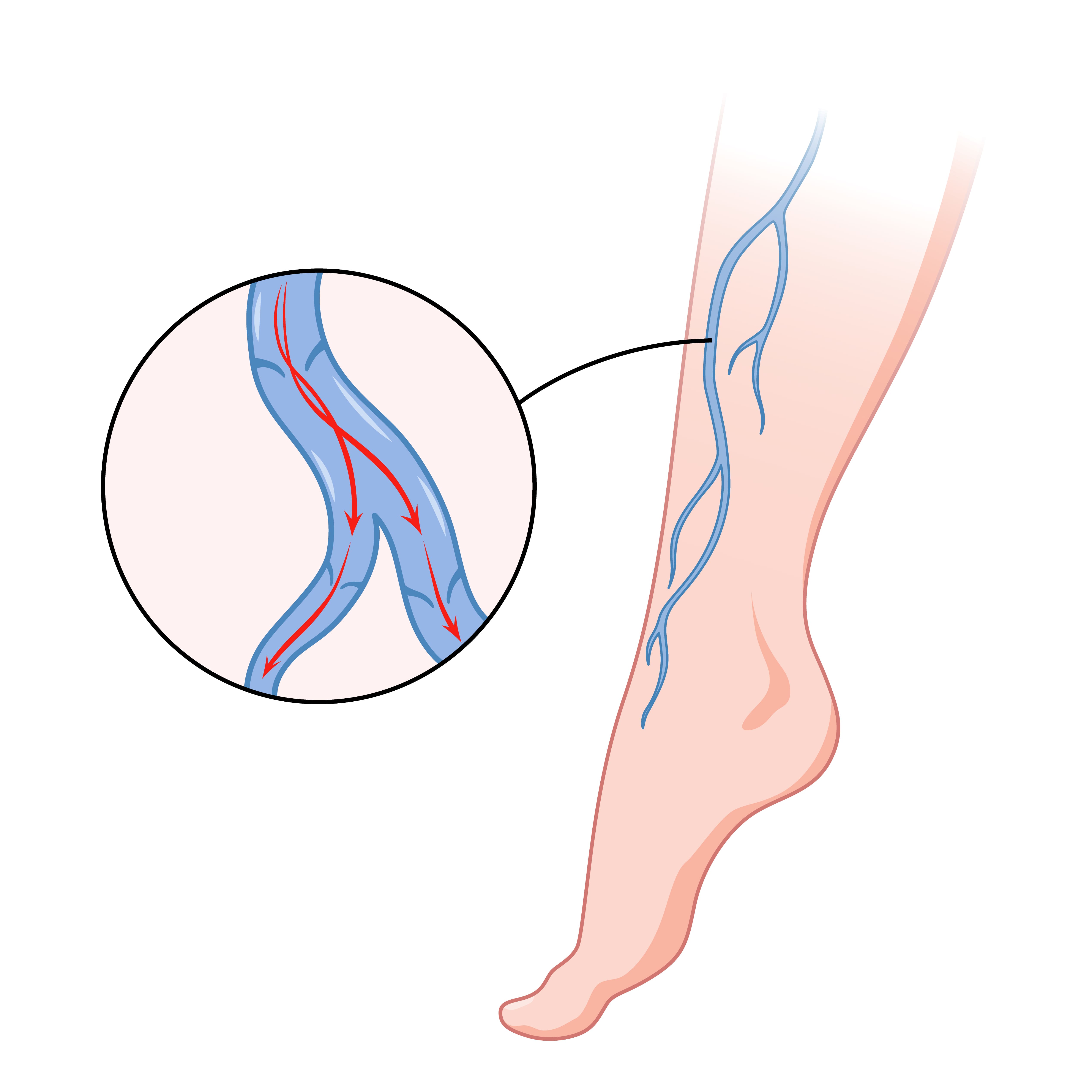 <strong><a href='tratamiento-de-flebitis-en-ecuador.php'><strong>Tratamiento de flebitis</strong> en <strong>Ecuador</strong></a></strong>