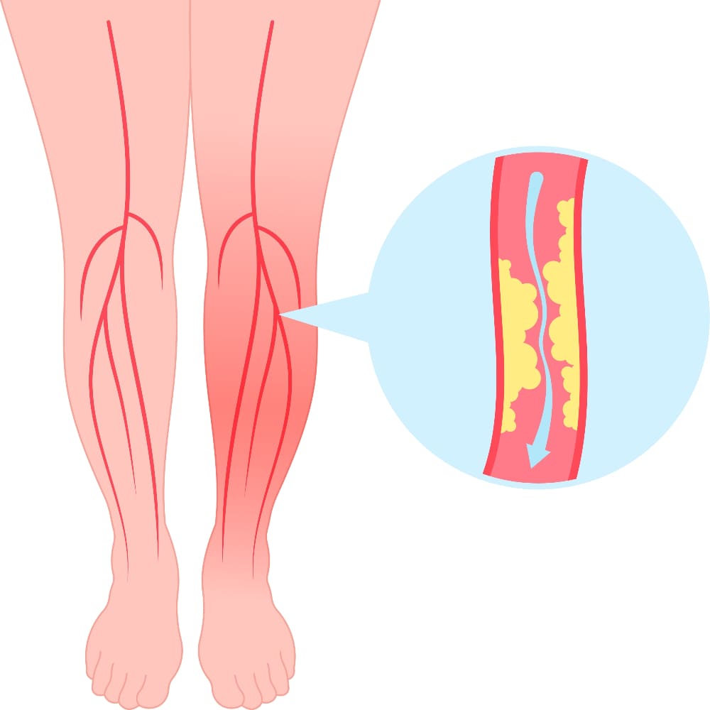 <strong><a href='tratamiento-de-sindrome-postrombotico.php'><strong>Tratamiento de síndrome</strong> <strong>postrombótico</strong></a></strong>