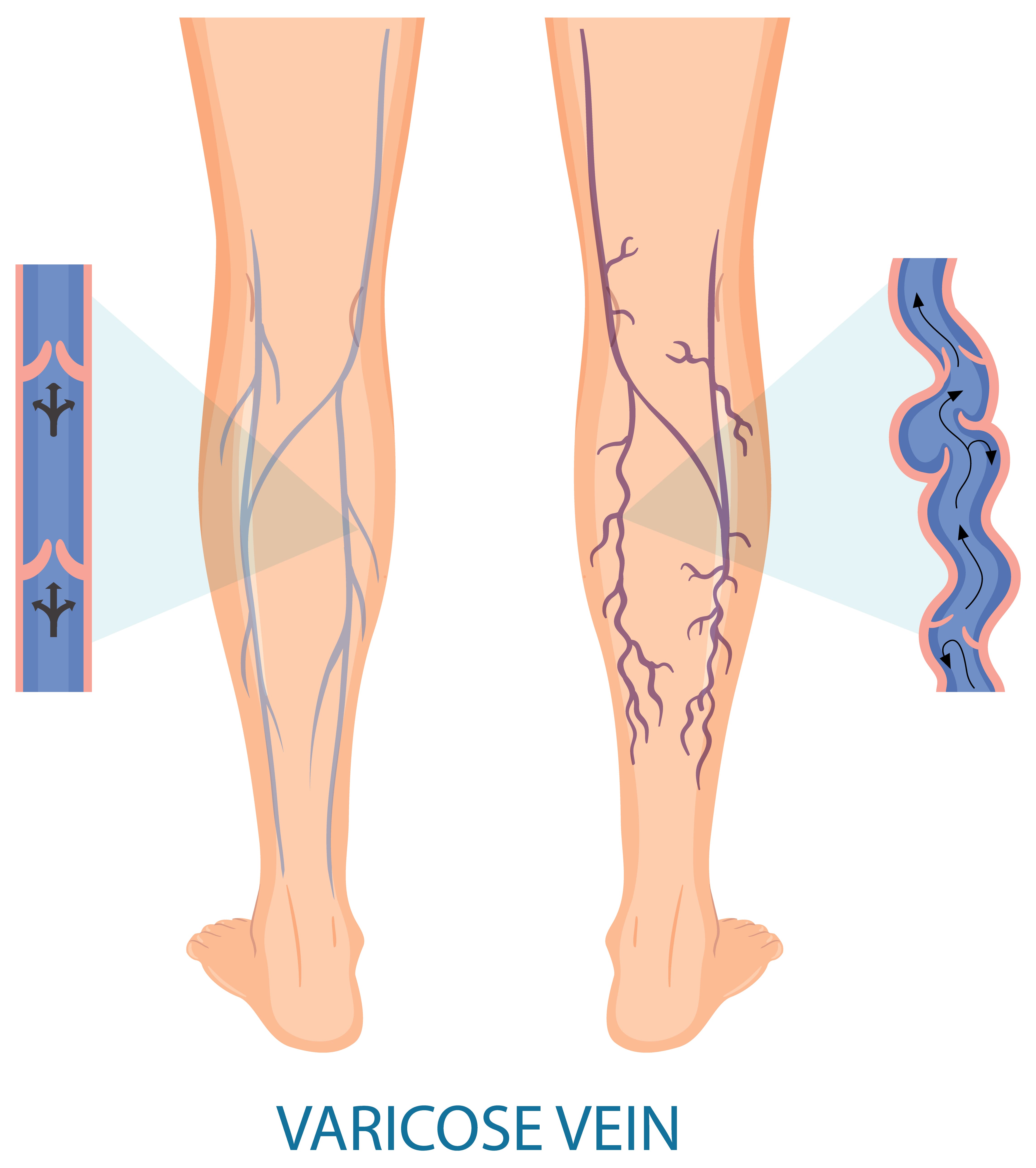 <strong>Tratamiento</strong> efectivo de <strong>trombosis</strong>